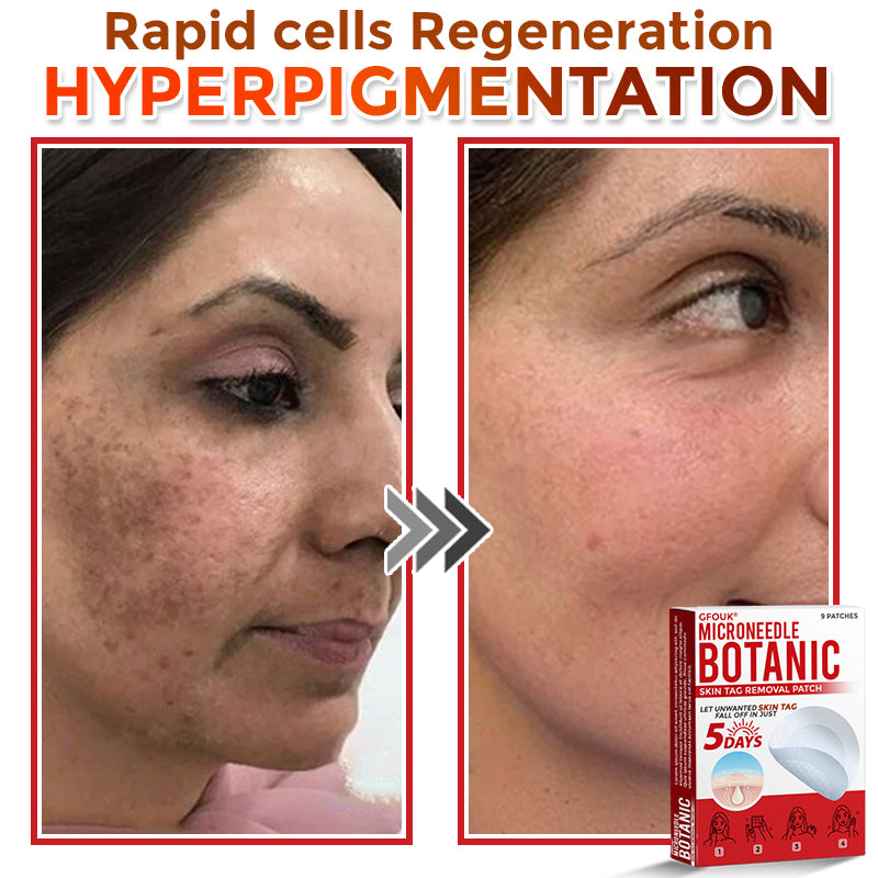 ๐ฎ๐ญ๐ถ๐ผ๐ฒยฎ MicroNeedle Botanic Skin Tag Removal Patch โ
๐๐๐ฎ๐ฌ๐ญ๐ซ๐๐ฅ๐ข๐๐ง ๐๐๐๐๐โ