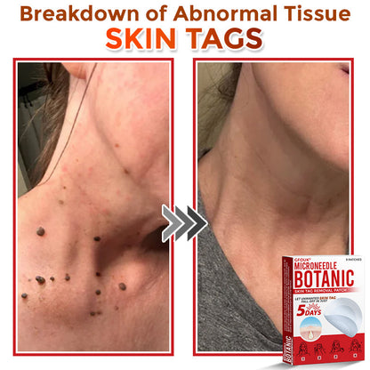 𝑮𝑭𝑶𝑼𝑲® MicroNeedle Botanic Skin Tag Removal Patch ✅Australian Made🌏✅