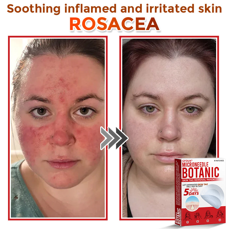 𝑮𝑭𝑶𝑼𝑲® MicroNeedle Botanic Skin Tag Removal Patch ✅Australian Made🌏✅