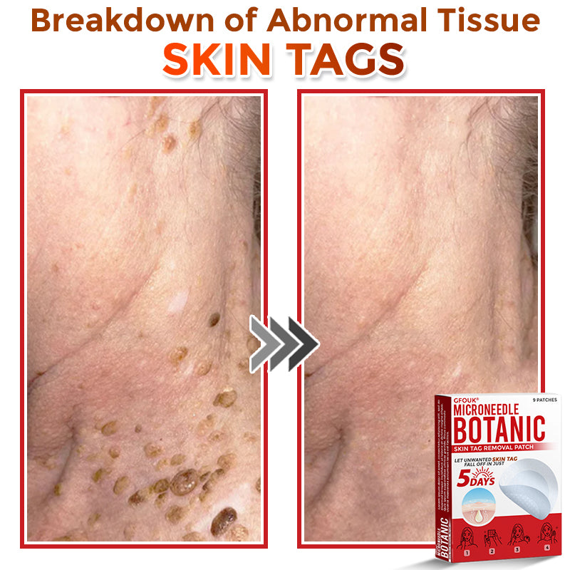 𝑮𝑭𝑶𝑼𝑲® MicroNeedle Botanic Skin Tag Removal Patch ✅Australian Made🌏✅