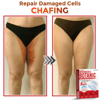 𝑮𝑭𝑶𝑼𝑲® MicroNeedle Botanic Skin Tag Removal Patch ✅Australian Made🌏✅