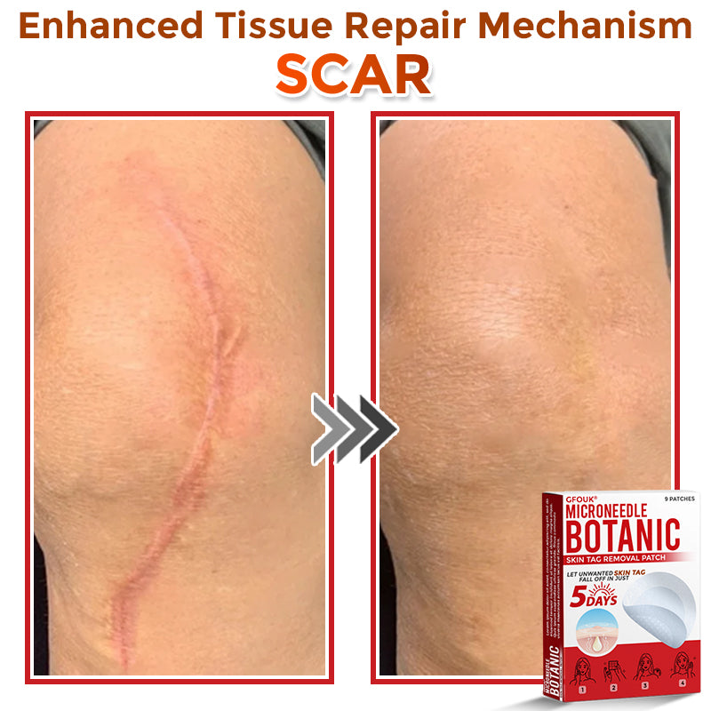 𝑮𝑭𝑶𝑼𝑲® MicroNeedle Botanic Skin Tag Removal Patch ✅Australian Made🌏✅